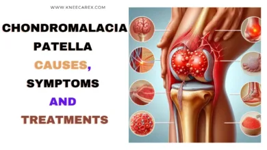 Chondromalacia Patella Causes, Symptoms and Treatments