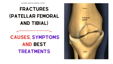 Fractures (Patellar Femoral and Tibial) Causes, Symptoms and Treatments