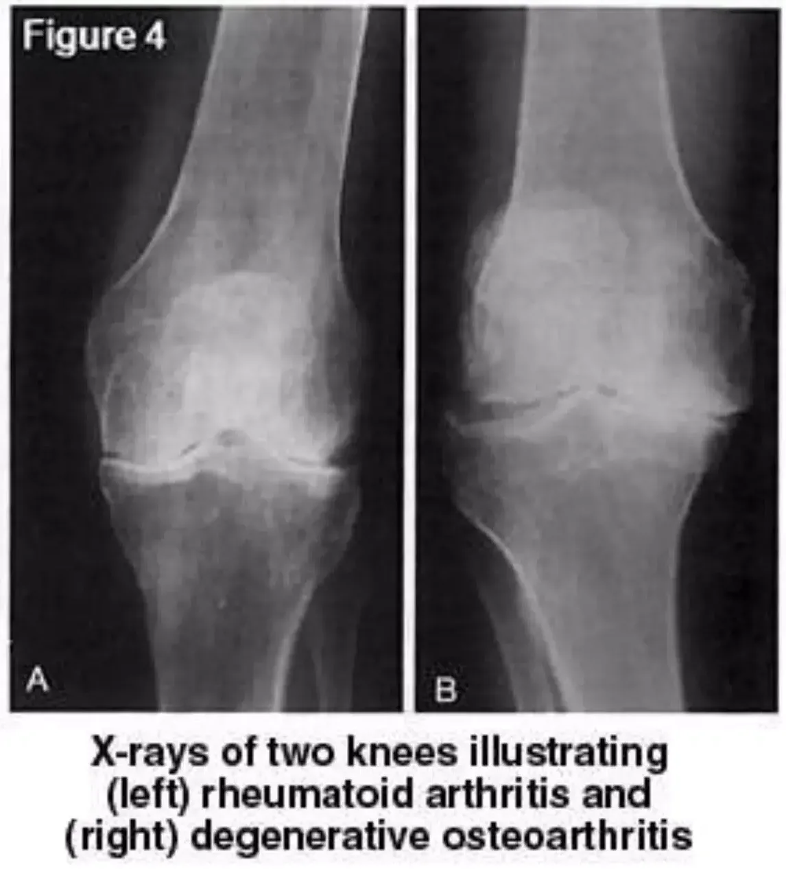 rheumatoid-arthritis-and-osteoarthritis